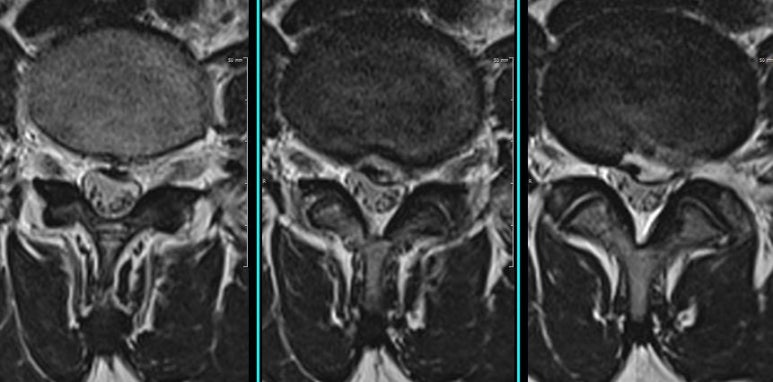 수술후 껍질만 남기고 잘 제거된 MRI