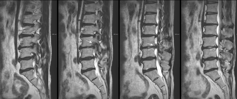 MRI 상에서 보면 제 3-4번의 추간공이 좁아져 있습니다. 그리고 내부에서도 디스크가 돌출되어 있는 것이 관찰됩니다. 횡단면에서도 관찰되는 협착의 소견이 안팎으로 존재하고 있습니다.